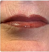 Close-up of chapped lips with a dry, cracked, reddish-brown patch on the lower lip