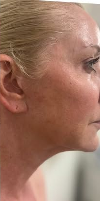 Close-up of a person’s face with visible cheek and neck wrinkles, eyes closed in profile