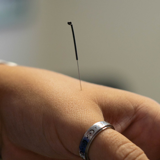 Acupuncture
