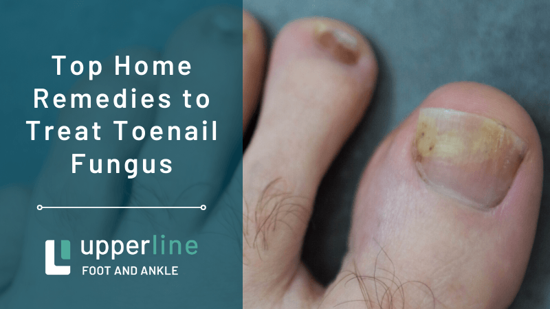 Home Remedies for Toenail Fungus Home Remedies for Toenail Fungus