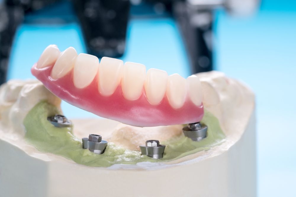 A Close Up Of A Denture On A Model Of A Person 's Teeth — Dentures Direct Taree-Rod Hinton In Taree, NSW