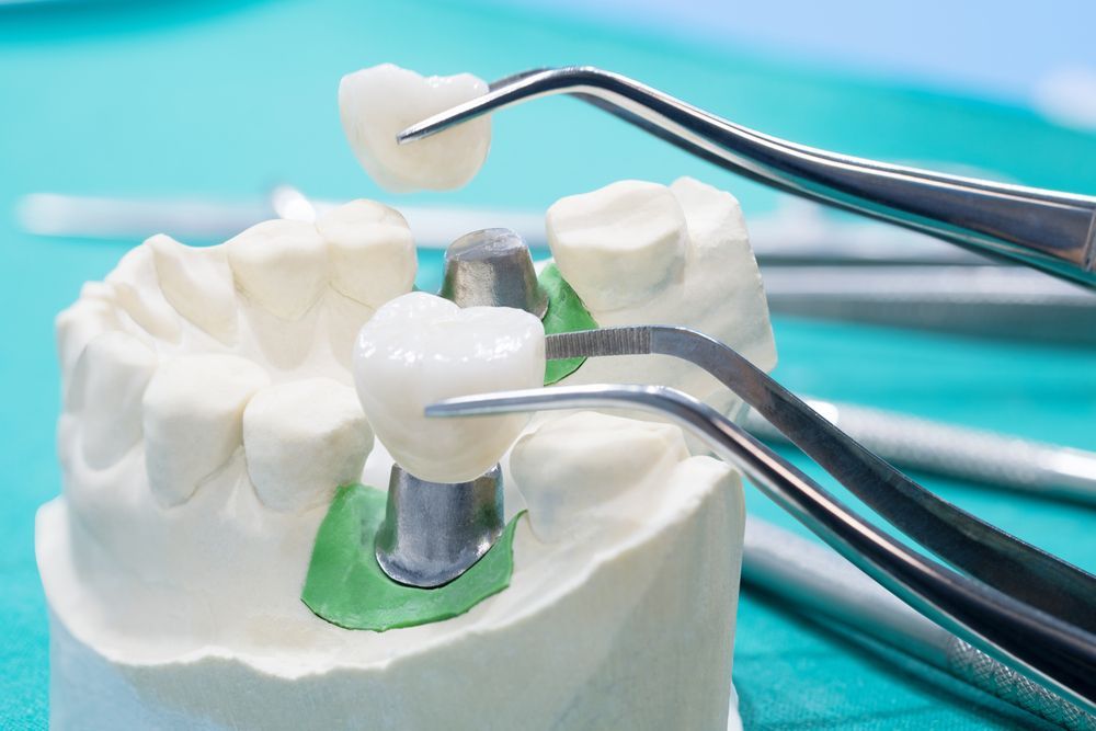 A Model Of A Tooth With A Crown On It And Dental Instruments — Dentures Direct Taree-Rod Hinton In Taree, NSW
