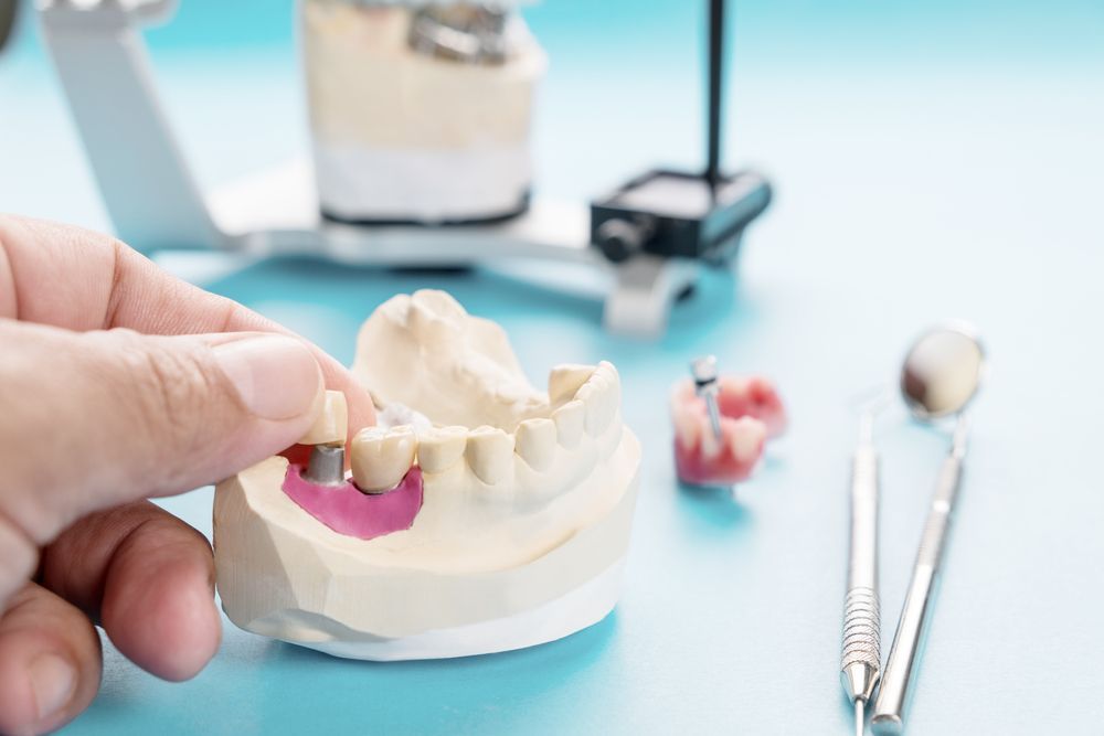 A Person Is Holding A Model Of A Tooth With A Dental Crown On It — Dentures Direct Taree-Rod Hinton In Taree, NSW