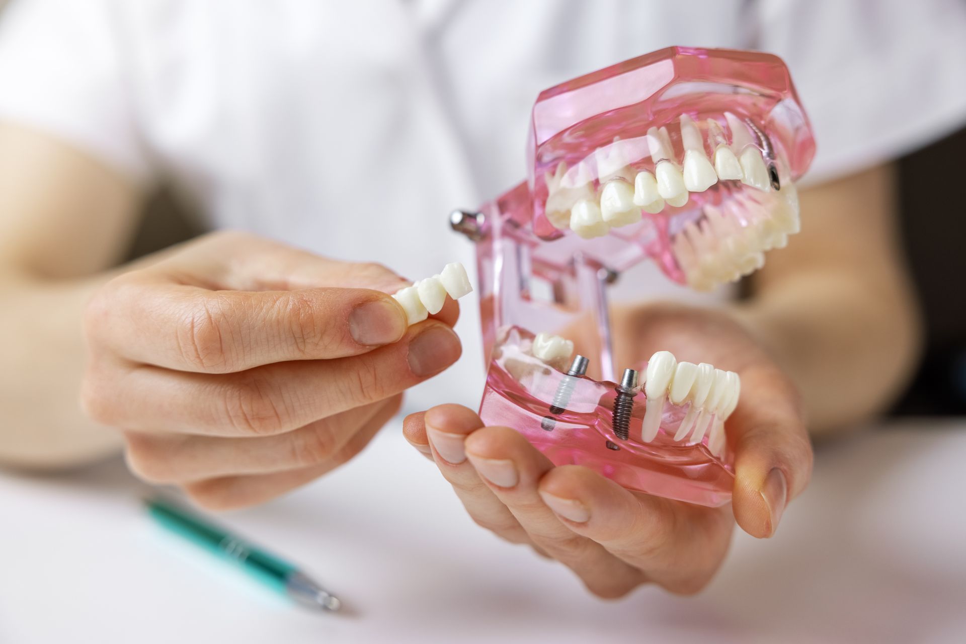 A Person Is Holding A Model Of Teeth With Dental Implants — Dentures Direct Taree-Rod Hinton In Wauchope, NSW