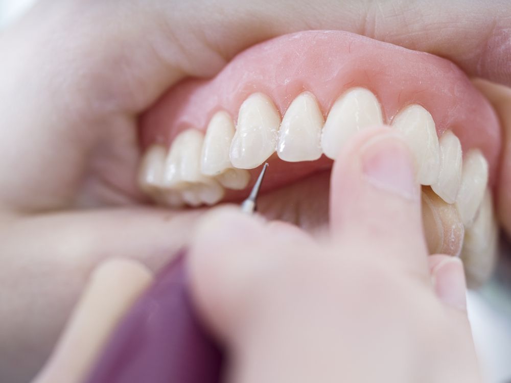 A Pair Of Dentures Are Sitting On Top Of Each Other On A Table — Dentures Direct Taree-Rod Hinton In Taree, NSW