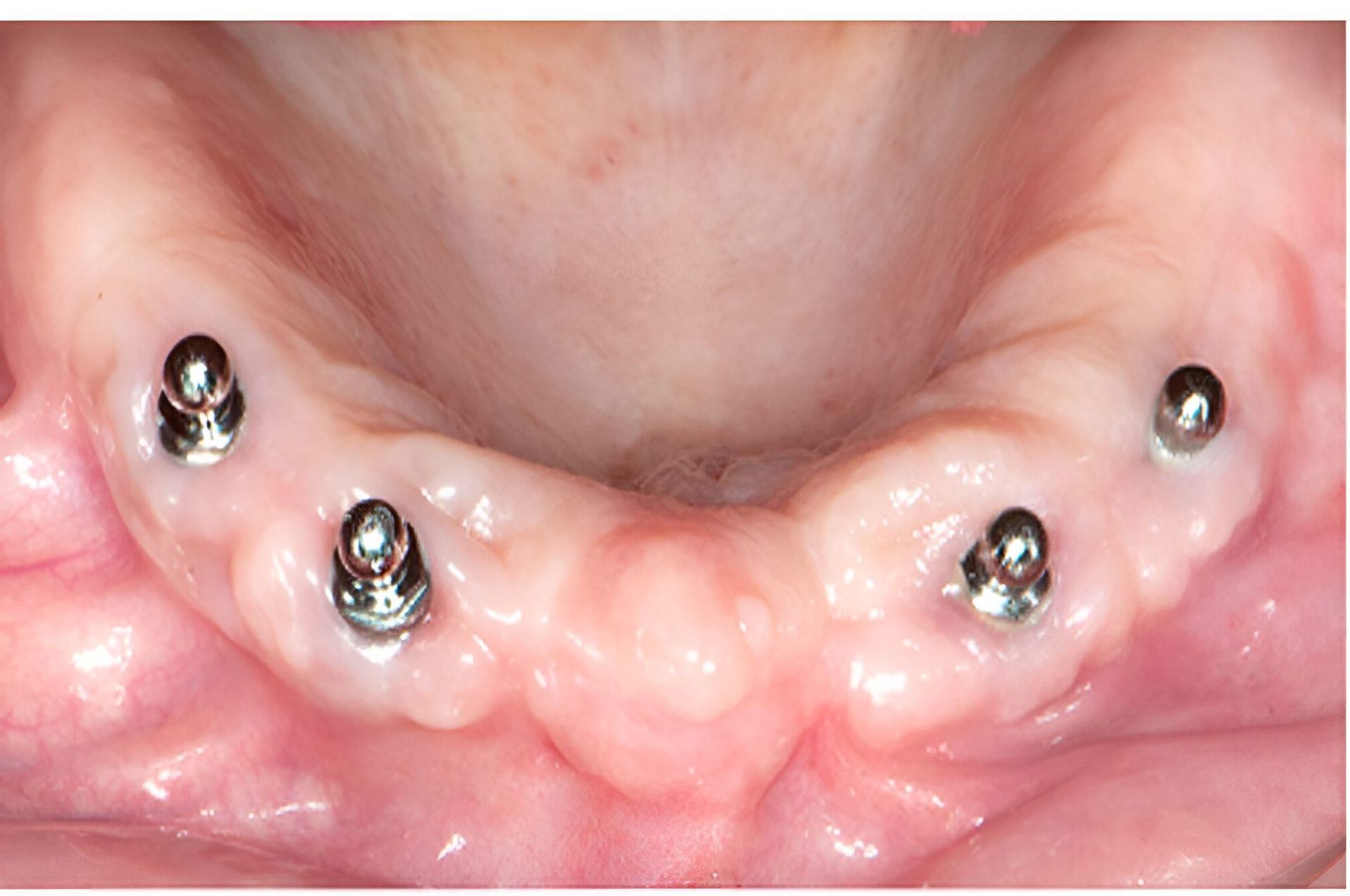A Close Up Of A Person 's Teeth With Screws In Them — Dentures Direct Taree-Rod Hinton In Taree, NSW