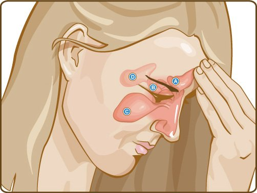sinusitis
