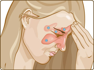 Illustration showing recurrent sinus infection pain areas in face