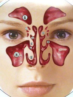 Functional endoscopic sinus surgery diagram showing sinus anatomy