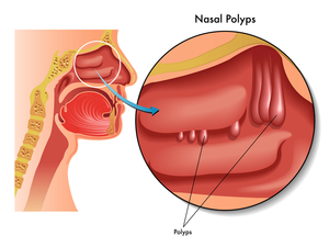Nasal polyps diagram showing growth inside sinus cavity