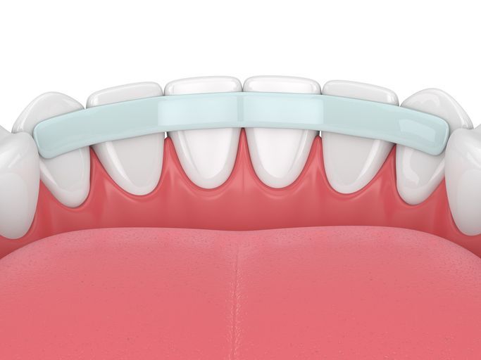 Close-up of a smiling mouth while a gloved hand applies white dental material to a front tooth.