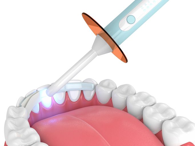 Dental light curing a white filling on lower teeth