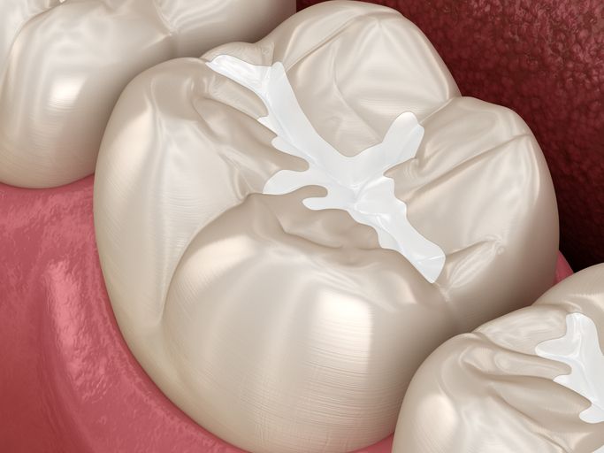 Close-up of molars with white dental sealant on the chewing surfaces