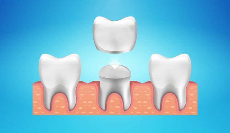 Illustration of three teeth in pink gums, with one tooth floating above the center tooth on a blue background