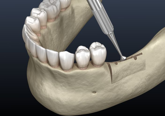 Dental drill working on lower jaw bone near molars