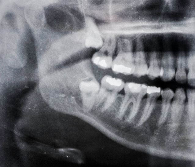 Dental X-ray showing side view of teeth and jaw with several fillings