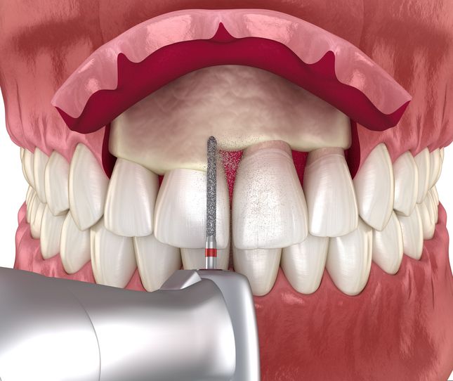 Dental model with upper front tooth implant being drilled using a handheld tool