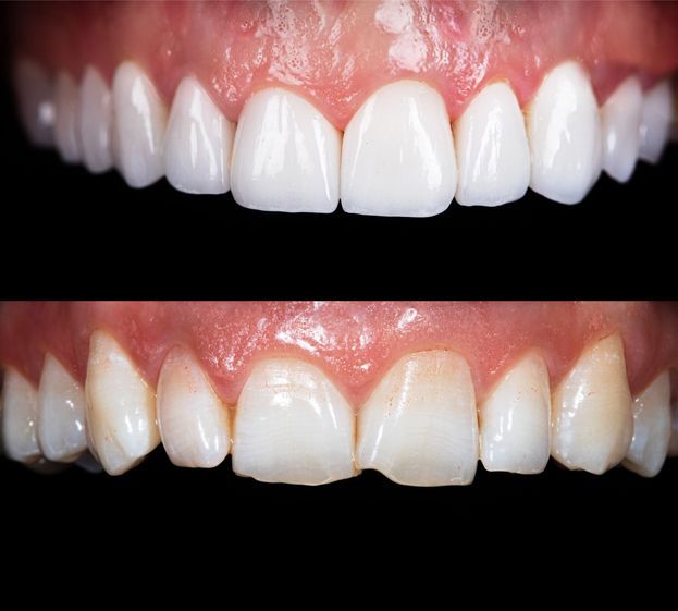 Top: bright white teeth; bottom: yellowed teeth, showing a before-and-after smile comparison.
