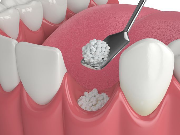 Dental bone grafting illustration with floss between teeth and white plaque debris in gums