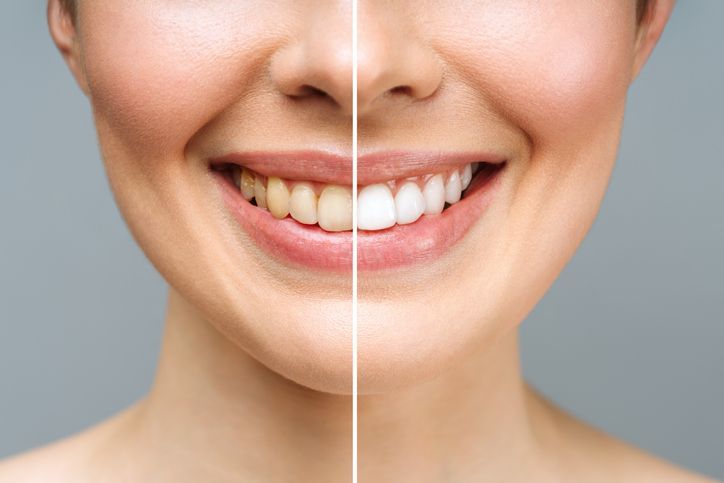 Split-screen close-up of a smiling mouth, showing teeth before and after whitening