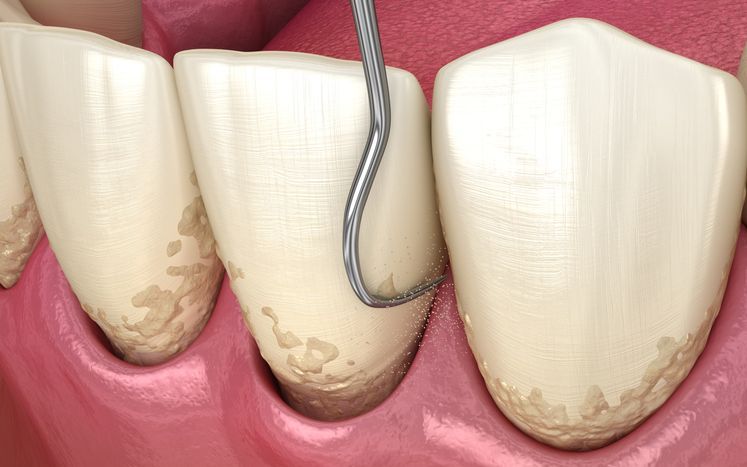 Dental crown being placed on a tooth in a pink gum model, with a blue background.