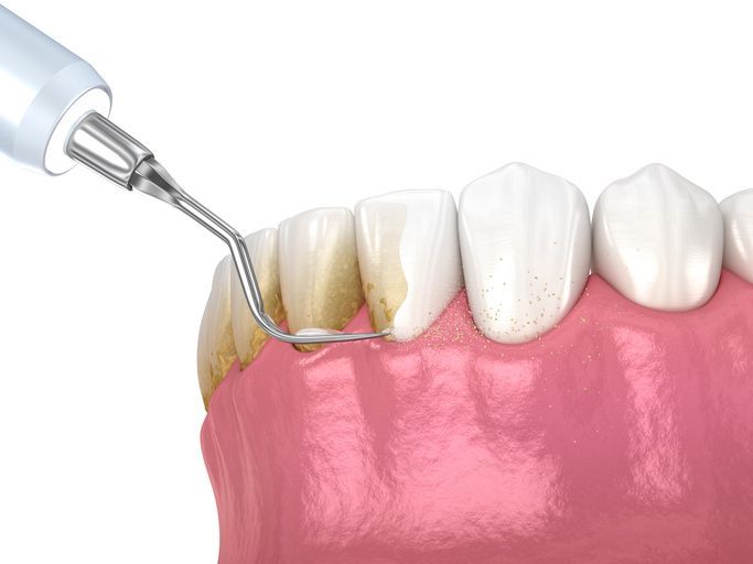Dental scaler cleaning plaque from a tooth near the gumline