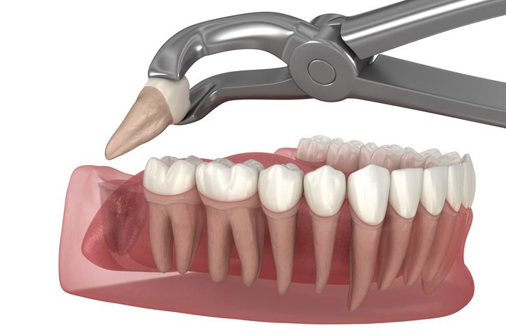 Dental model with pliers lifting a tooth from pink gums and white teeth