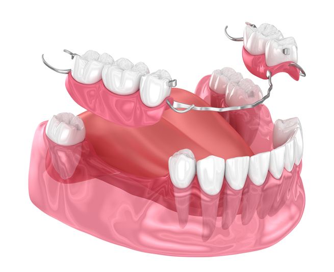 3D dental model showing a full denture fitting over gums and teeth in pink and white