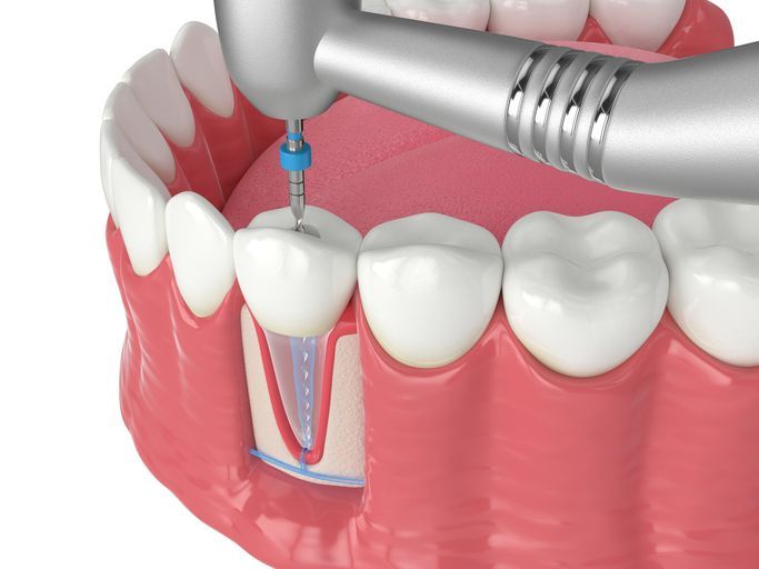 Dental drill shaping a tooth with visible root canal diagram in pink gums