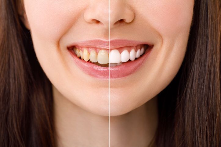 Close-up of a smiling mouth with a vertical split showing yellow teeth on one side and white teeth on the other