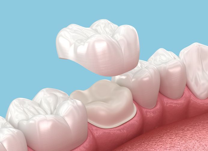 Dental crown being placed on a tooth in a pink gum model, with a blue background.
