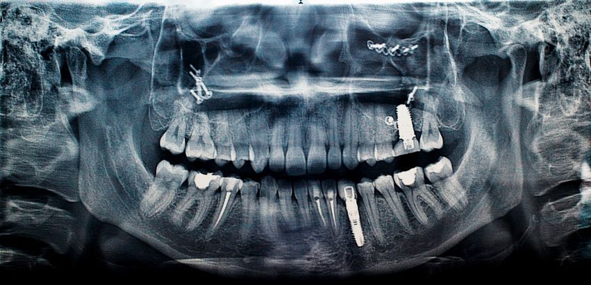 Panoramic dental X-ray showing teeth, jawbones, and a few dental implants.