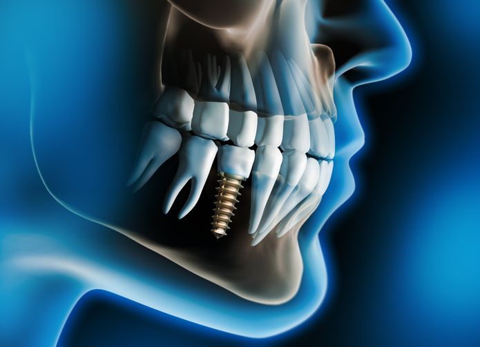 X-ray of jaw with dental implant and metal screw in the lower molar area