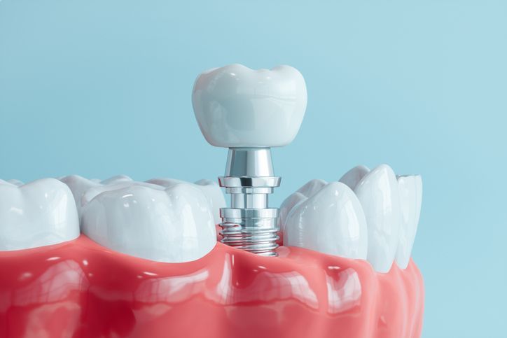 Dental implant with white crown in red gums against a light blue background