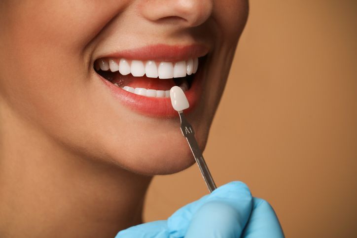 Close-up of a smiling mouth while a gloved hand applies white dental material to a front tooth.