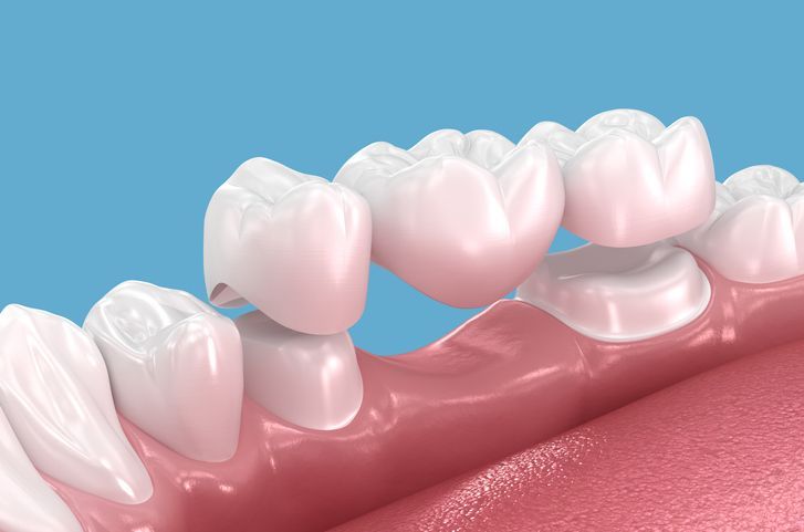Illustration of a dental bridge fitting between pink gums and white teeth on a blue background