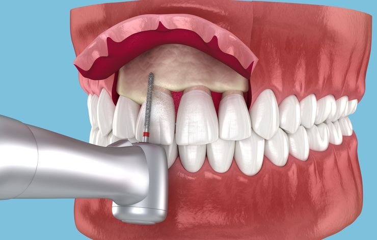 Dental drill removing plaque from front teeth in a mouth model with pink gums and white teeth