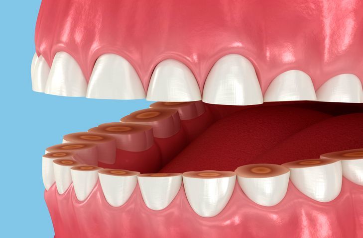 Mouth with upper and lower teeth, showing a row of loose brown teeth inside the open jaw