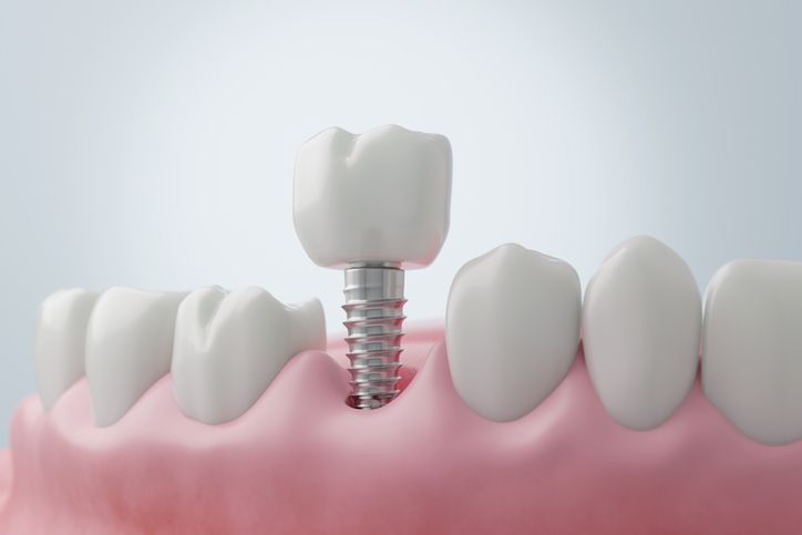 Dental implant with white crown anchored in pink gums among natural teeth
