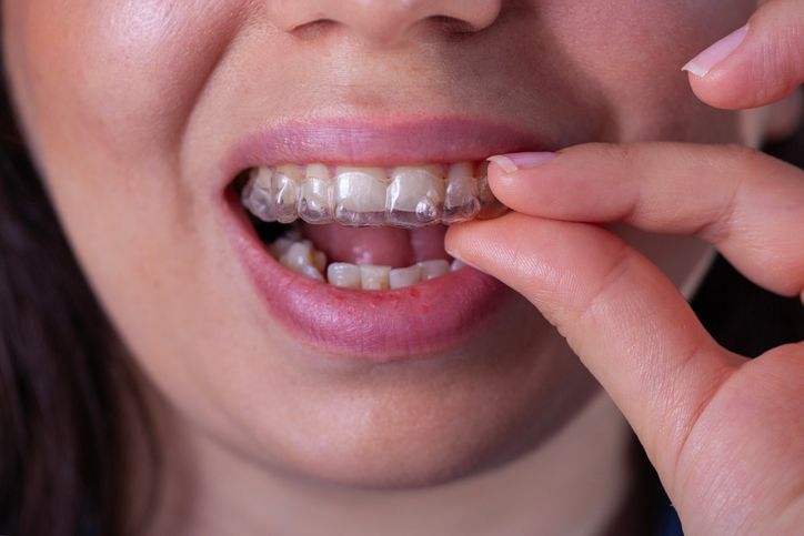 Close-up of a person fitting clear aligners onto their teeth