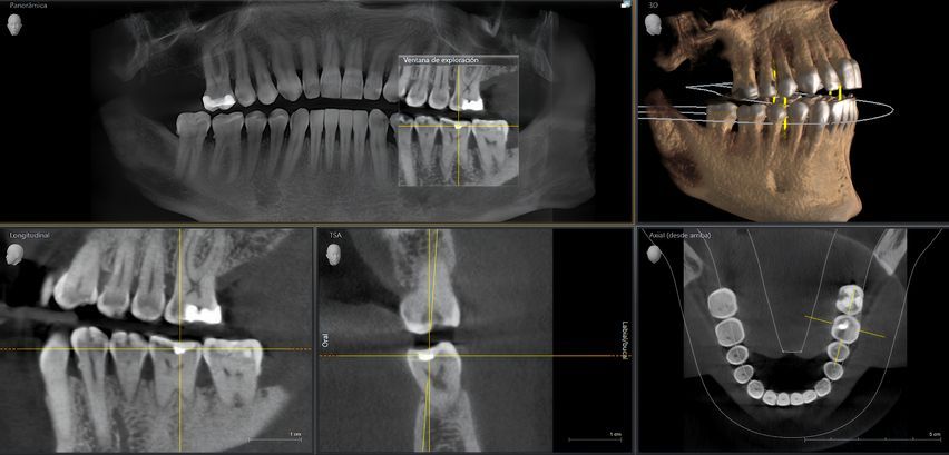 Dental X-ray collage showing full-mouth panoramic and close-up views of teeth and jaw.