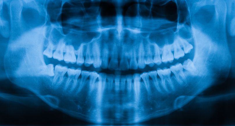 Blue-tinted panoramic dental X-ray showing the full upper and lower teeth and jawbone