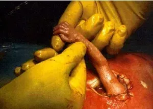 Gloved hands holding a small umbilical cord stump on a newborn’s red skin, close-up medical scene