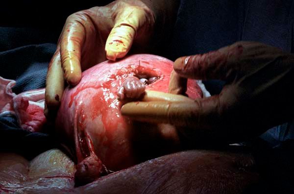 Hands hold a bloody newborn’s head during a medical delivery procedure