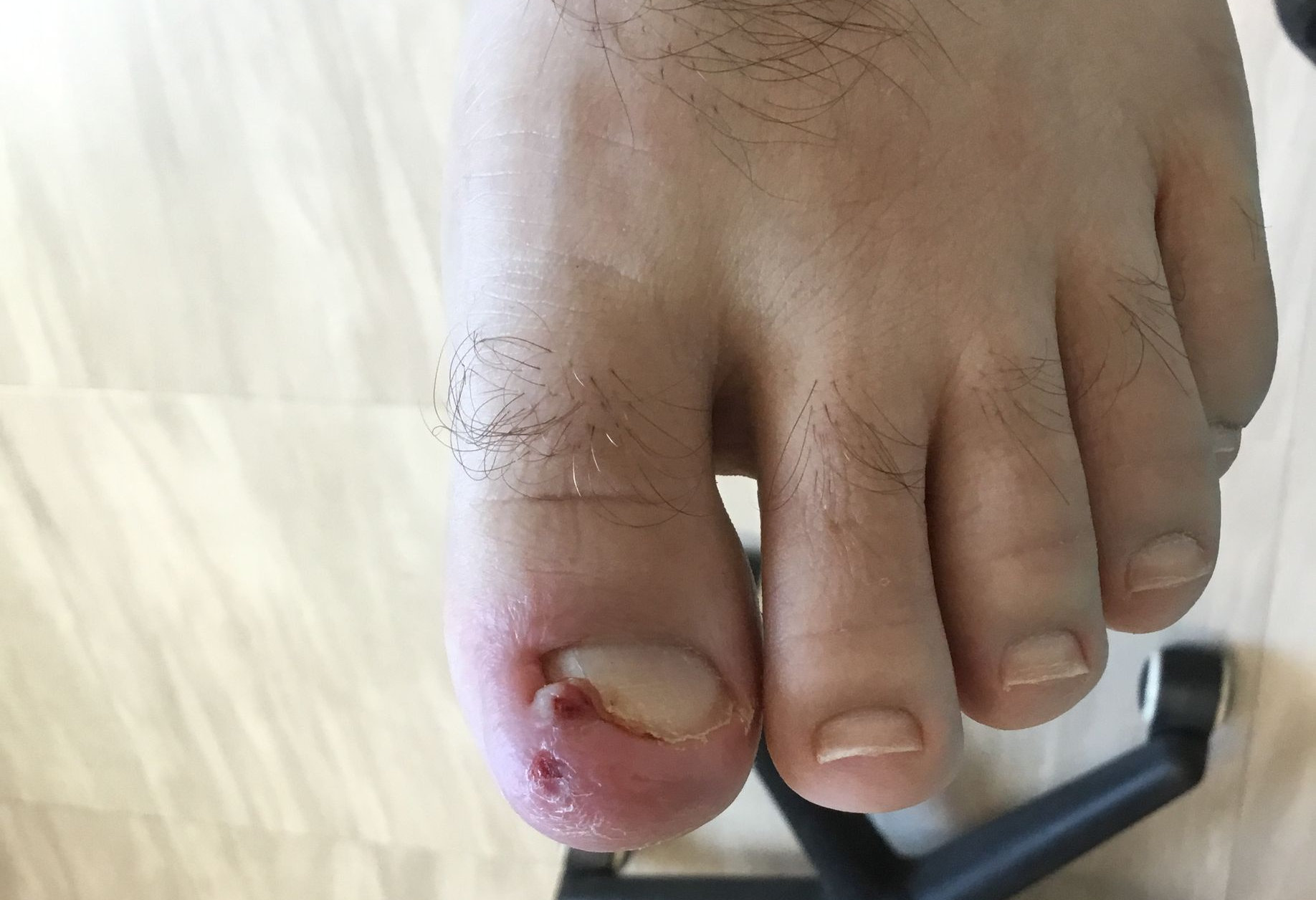 Close-up of a swollen, ingrown toenail with a small wound near the nail on a foot.