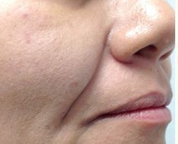 Before Man 's Face With Blue Eyes — Saint Johns, FL — Live Without Lines Med Spa