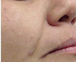 After Man 's Face With Blue Eyes — Saint Johns, FL — Live Without Lines Med Spa