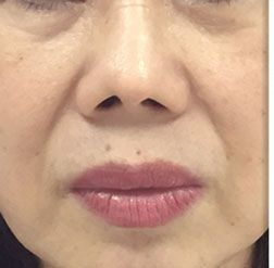 Before Man 's Face With Blue Eyes — Saint Johns, FL — Live Without Lines Med Spa