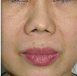 After Man 's Face With Blue Eyes — Saint Johns, FL — Live Without Lines Med Spa