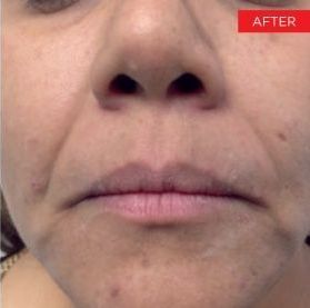After Man 's Face With Blue Eyes — Saint Johns, FL — Live Without Lines Med Spa